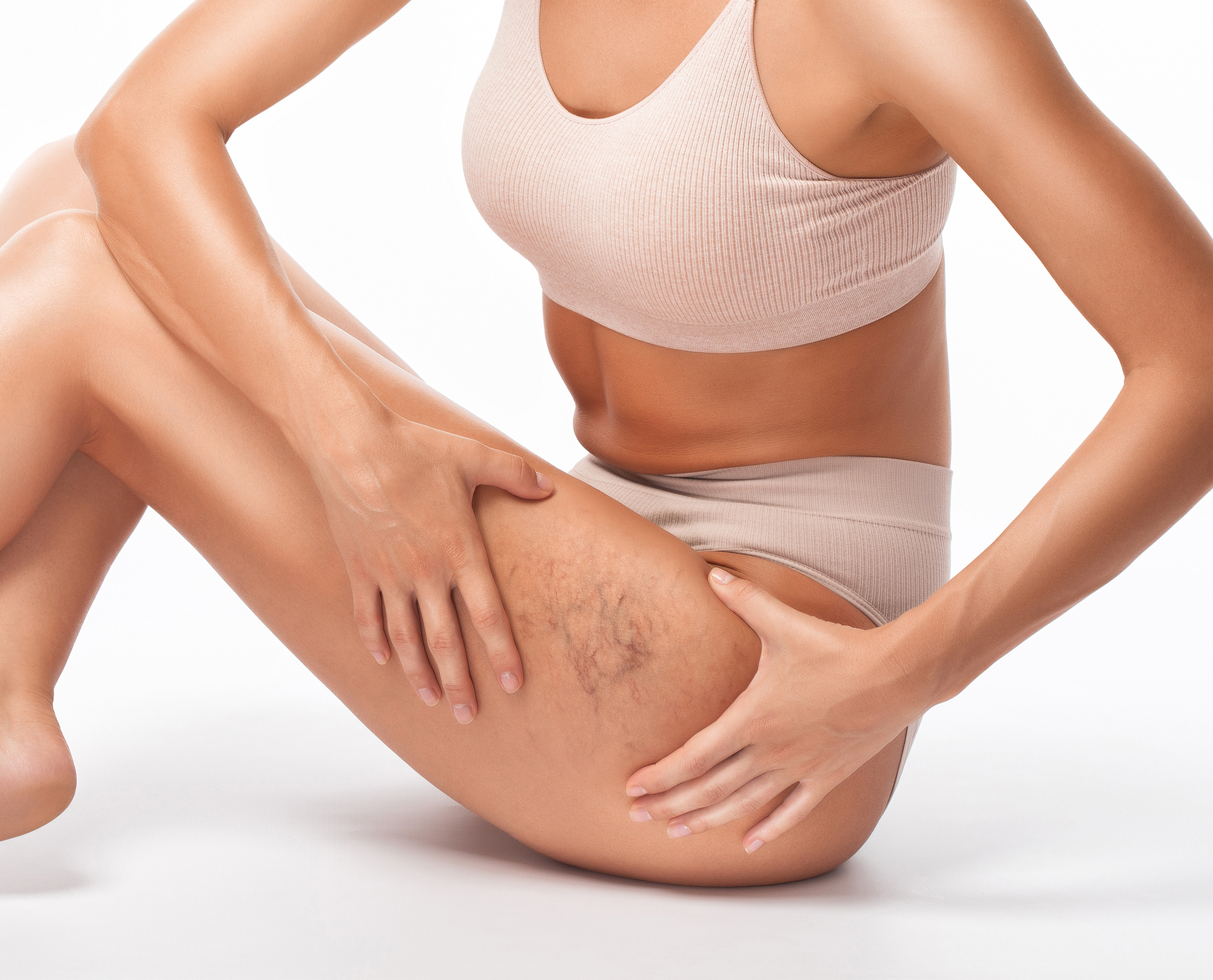 Miami Varicose Veins Treatment